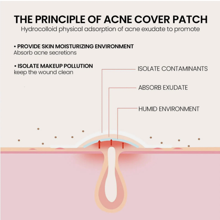 StarGlow Skincare Hydrocolloid  Star Acne Patches ( 240-Pack)